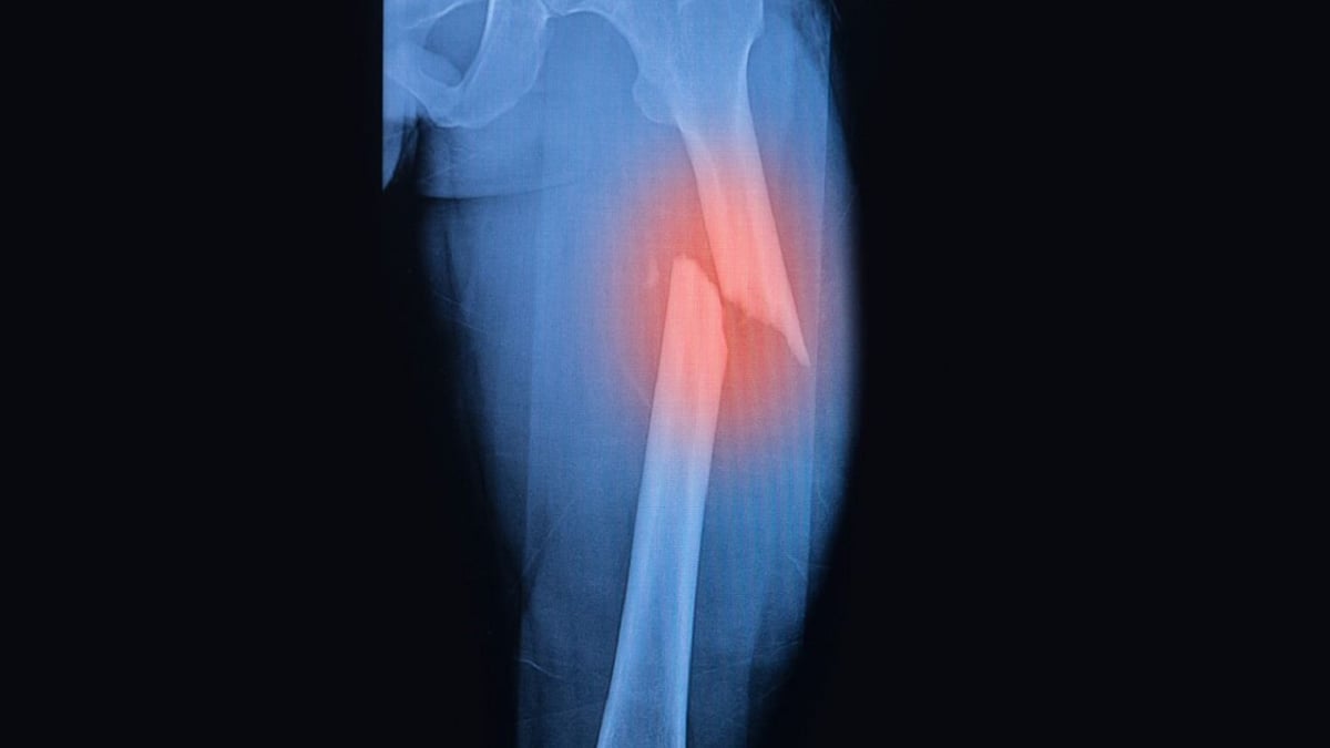 "شفاء أسرع".. الكشف عن تقنية جديدة لعلاج العظام المكسورة